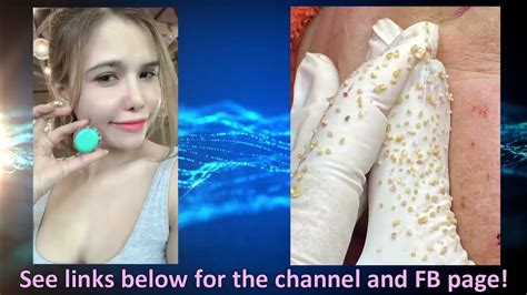 Feb 23, 2021 · Top 3 crazy Poppers and pimple PoppingHi Guys,Welcome to her fix, on this channel I share a few of favourites and or most interested videos of the week. The ... 